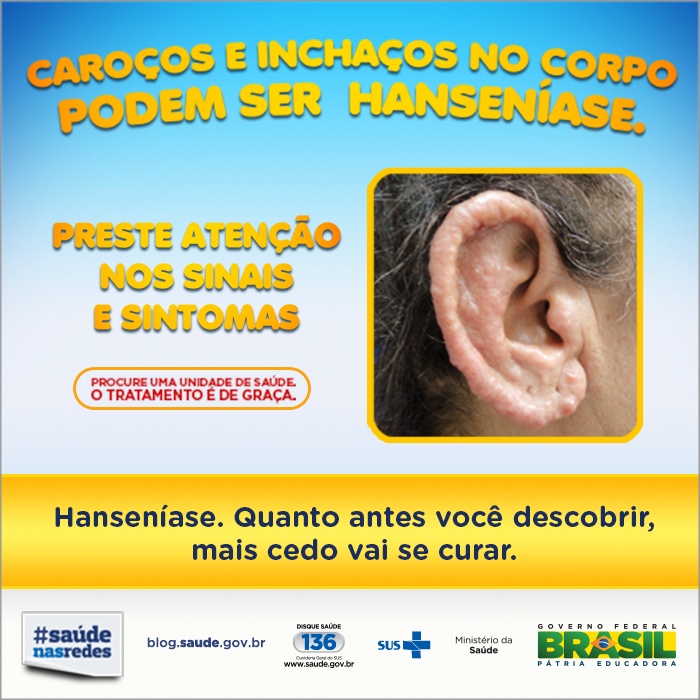 Hanseníase detectada em fase inicial tem cura - Prefeitura de Aracaju