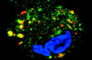 Imagem mostra macrófago infectado com Mycobacterium leprae (em vermelho) durante o silenciamento da expressão do gene OASL. Durante a redução da expressão desse gene, foi observado o direcionamento da bactéria para o autofagossomo (em amarelo), caracterizando um processo importante na eliminação do patógeno e confirmando a importância do OASL na regulação da resposta imune do hospedeiro. (Crédito da foto: Laboratório de Hanseníase do IOC)